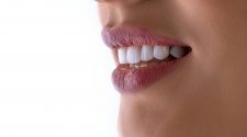Smiling woman showing bright teeth after dental implants in Turkey